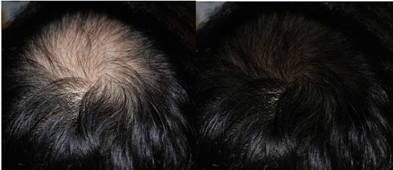 HAIR LOSS CLINIC TORONTO | SMP, AAPE, PRP, TRICHOLOGY
